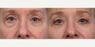 Eyelid Surgery before and after photo