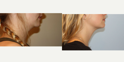 Kybella before and after photo