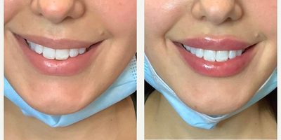 Lip Fillers before and after photo