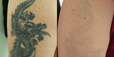Tattoo Removal before and after photo