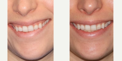 Botox for Gummy Smile before and after photo