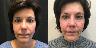 Botox before and after photo