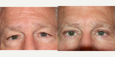 Eyelid Surgery before and after photo