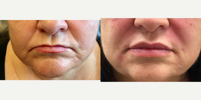 Juvederm before and after photo