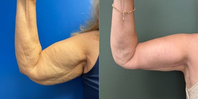 Arm Lift before and after photo