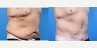 Body Lift before and after photo