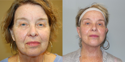 Facelift before and after photo