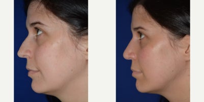 Rhinoplasty before and after photo