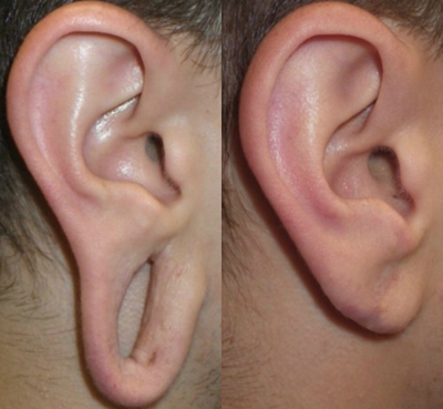 Earlobe Repair before and after photo