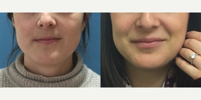 Lip Fillers before and after photo