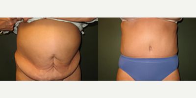 Tummy Tuck before and after photo