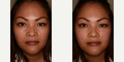 Belotero before and after photo