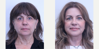 Facelift before and after photo