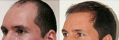 NeoGraft before and after photo