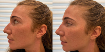 Nonsurgical Nose Job before and after photo