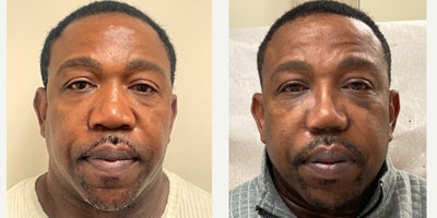 Rhinoplasty before and after photo