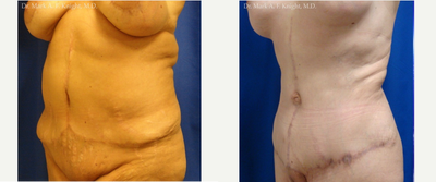 Body Lift before and after photo