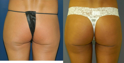 Brazilian Butt Lift before and after photo