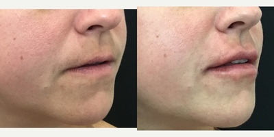 Lip Fillers before and after photo