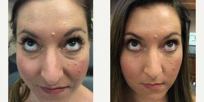 Belotero before and after photo