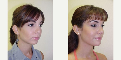 Chin Implant before and after photo