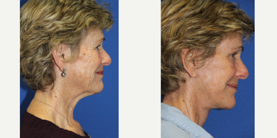 Facelift before and after photo