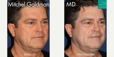 Fraxel Laser before and after photo