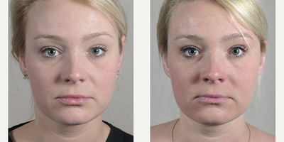 Halo Laser before and after photo