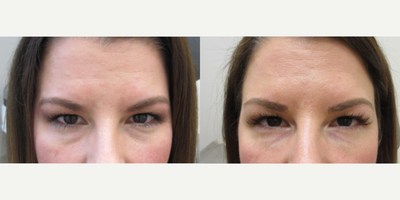 Juvederm before and after photo
