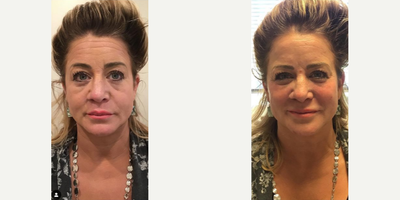Botox before and after photo