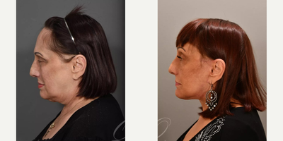 Brow Lift before and after photo