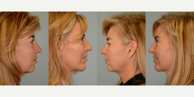 Chin Implant before and after photo