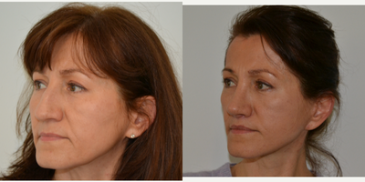 Facelift before and after photo