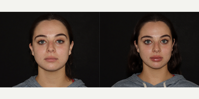 Lip Fillers before and after photo