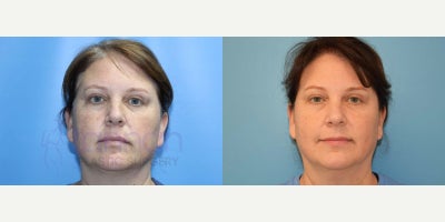 Morpheus8 before and after photo