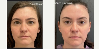 Sofwave before and after photo