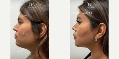 Buccal Fat Removal before and after photo