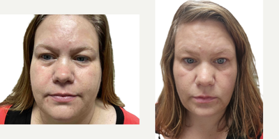 CO2 Laser before and after photo
