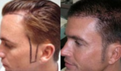 Hair Loss Treatment before and after photo
