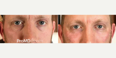Hyaluronidase before and after photo