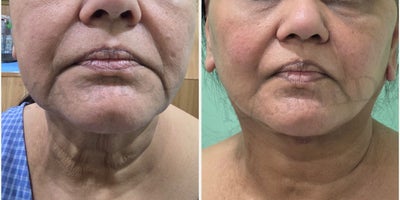 Neck Lift before and after photo