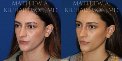 Nonsurgical Nose Job before and after photo