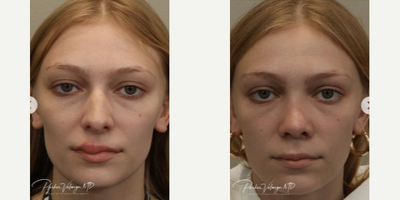 Rhinoplasty before and after photo