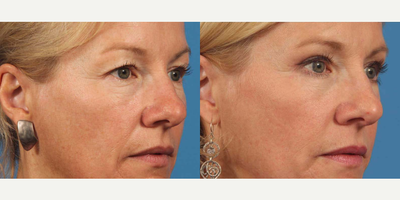Eyelid Surgery before and after photo