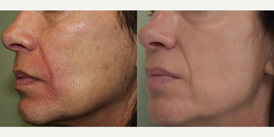 IPL before and after photo
