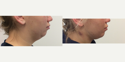 Liposuction before and after photo