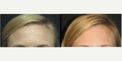 Botox before and after photo