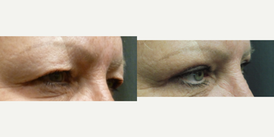 Eyelid Surgery before and after photo