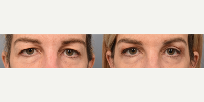 Eyelid Surgery before and after photo