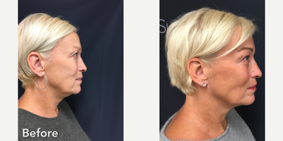 Laser Resurfacing before and after photo